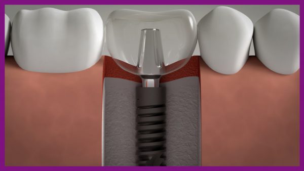 trồng răng implant giúp ngăn ngừa tình trạng tiêu xương hàm xảy ra ở người mất răng lâu năm