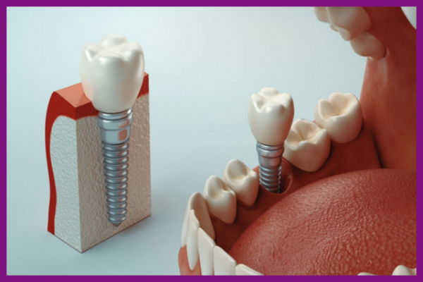 răng implant có tính ứng dụng cao, linh động trong mọi trường hợp mất răng