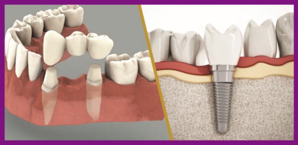 Cầu răng và implant là hai biện pháp phổ biến nhất hiện nay