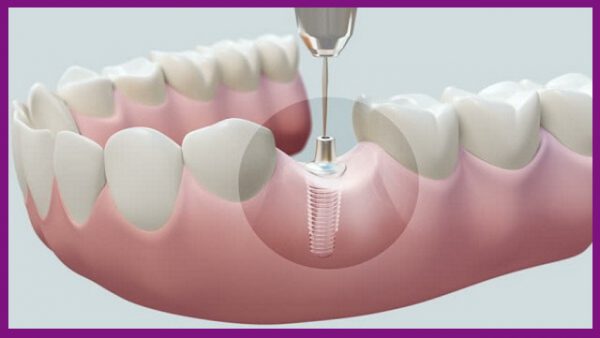 trồng răng implant có tuổi thọ lâu bền, vĩnh viễn với thời gian sử dụng