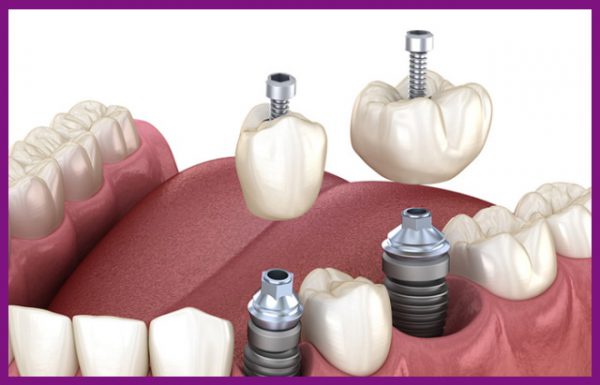 trụ implant đóng vai trò thay thế cho chân răng thật nên rất bền chắc
