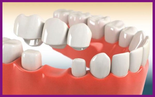 việc mài hai răng kế cạnh trong biện pháp cầu răng sứ sẽ làm răng nhanh chóng yếu đi