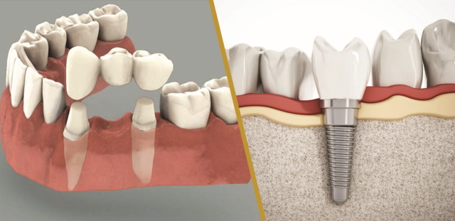 Cầu răng và implant - Biện pháp phục hình răng nào tốt hơn?