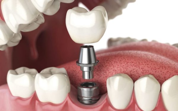 tìm hiểu cấu tạo răng implant