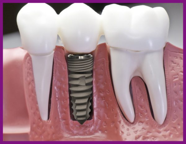 Răng implant có tuổi thọ lâu, bền với thời gian sử dụng