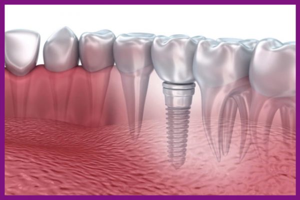 trồng răng implant - giải pháp phục hồi chức năng răng hiệu quả nhất hiện nay