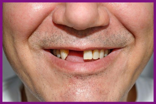 Mất răng có thể ảnh hưởng đến các răng còn lại