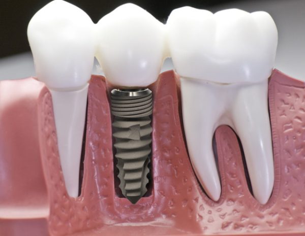 Có nên cấy chân răng implant không?