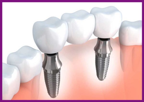 cầu răng sứ implant dành cho khách hàng bị mất 3 răng liên tiếp nhau