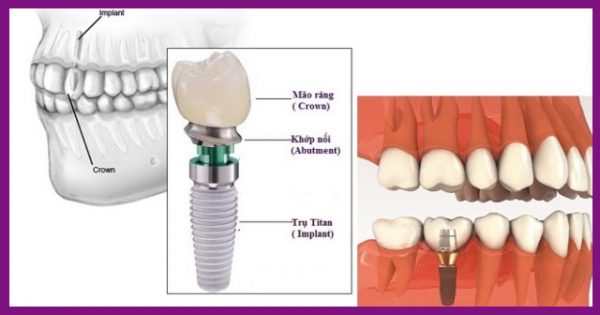 trồng implant rất thích hợp với những người mất răng toàn hàm