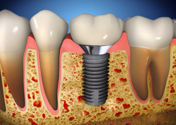 Các phương pháp giúp rút ngắn thời gian cay ghep implant