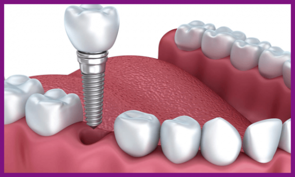 trồng răng implant phục hồi chức năng ăn nhai tốt hơn