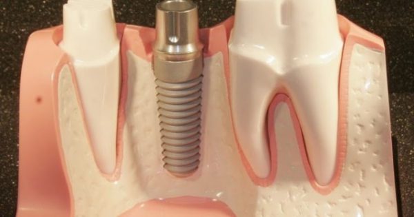 Cấy ghép implant là gì? Đây có thực sự là biện pháp trồng răng hoàn hảo?