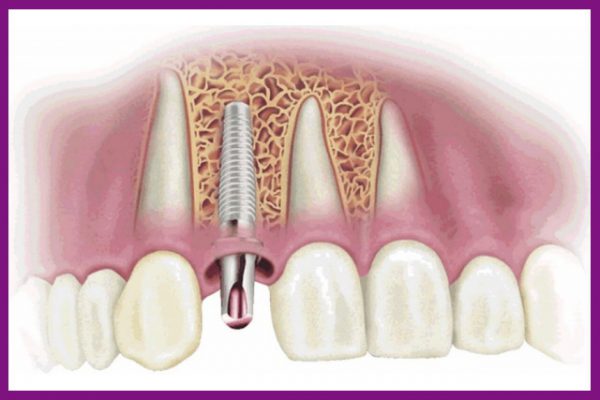 cấy implant là giải pháp phục hình răng tốt nhất hiện nay