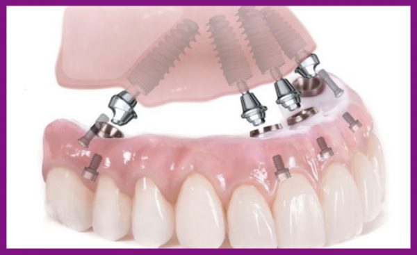 cấy implant không dành cho người mắc các bệnh về răng miệng
