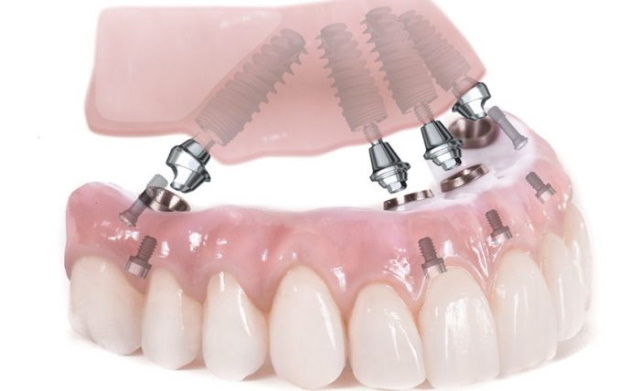 Cấy implant và các lưu ý để có phẫu thuật cấy răng thuận lợi