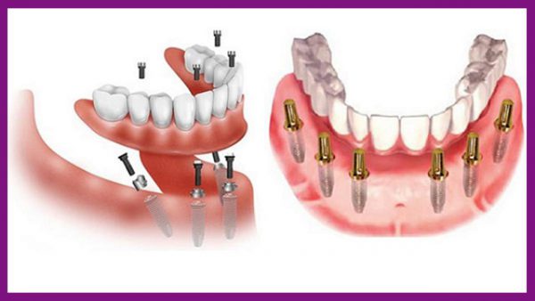 trồng răng all-on-4 sẽ không cần thực hiện ghép xương trước khi phẫu thuật