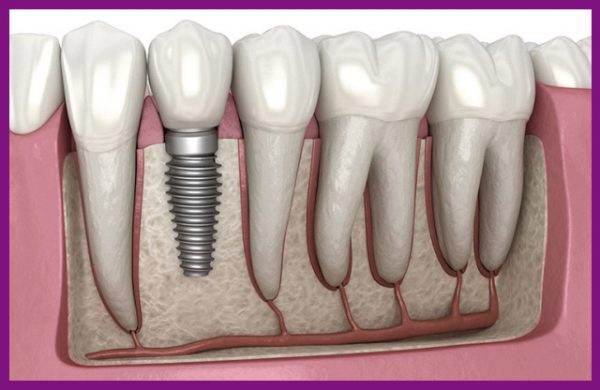 Cấy răng implant tức thì sau nhổ răng đang được ưa chuộng nhất hiện nay vì rút ngắn thời gian chờ đợi