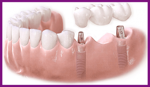 trồng răng implant - kỹ thuật phục hình răng thẩm mỹ và chức năng ăn nhai tốt nhất hiện nay