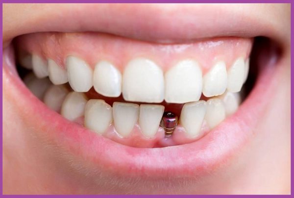 Trồng răng implant không đau vì được gây tê