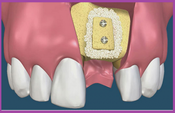Trồng răng implant là gì