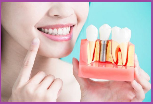 Chăm sóc răng implant cẩn thận để răng đẹp, bền, hạn chế biến chứng