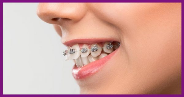 niềng răng sẽ giúp kéo chỉnh răng về đúng vị trí