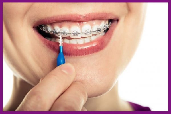 chi phí niềng răng 1 hàm trên phụ thuộc vào tình trạng răng miệng của từng người