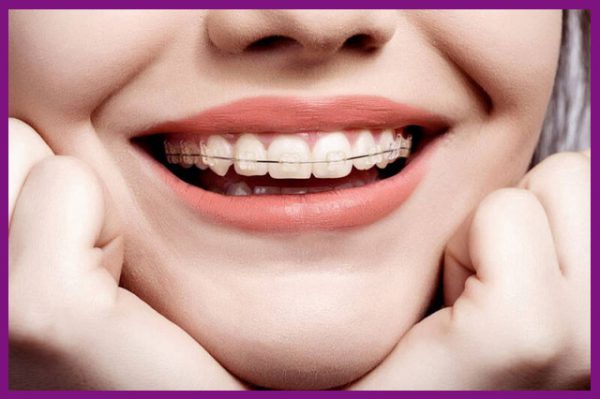 niềng răng là biện pháp mang lại hiệu quả chỉnh nha cao