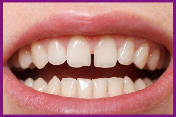 răng hàm trên thưa có thể thực hiện mỗi răng hàm trên