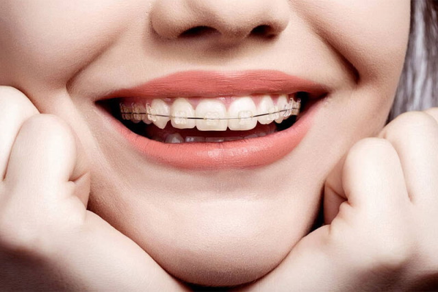 Chi phí niềng răng 1 hàm trên hiện nay là bao nhiêu?