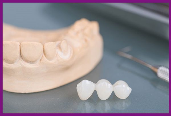 chất liệu của mão răng implant thường làm bằng sứ