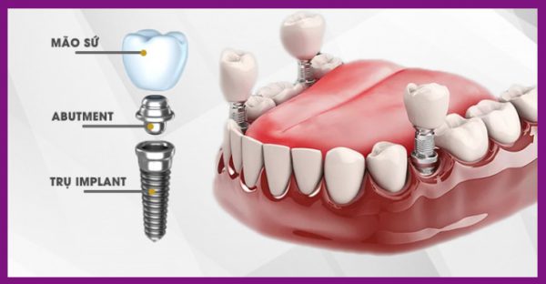 trồng răng implant rất bền chắc, không dễ bị tác động bởi lực nhai