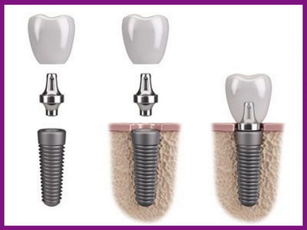 trồng răng implant là giải pháp phục hồi răng số 6 tốt nhất hiện nay