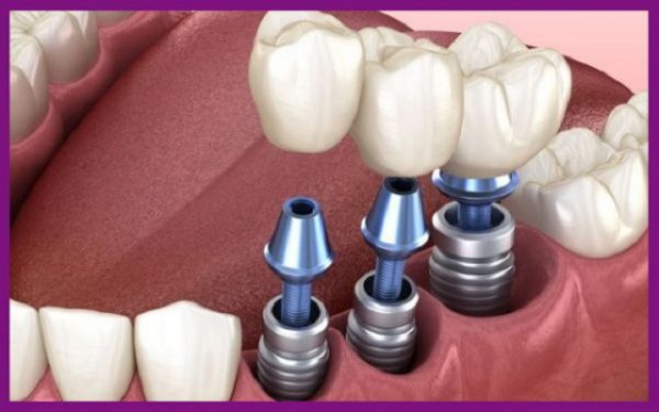 Cắm implant - giải pháp hoàn hảo cho mọi tình huống mất răng