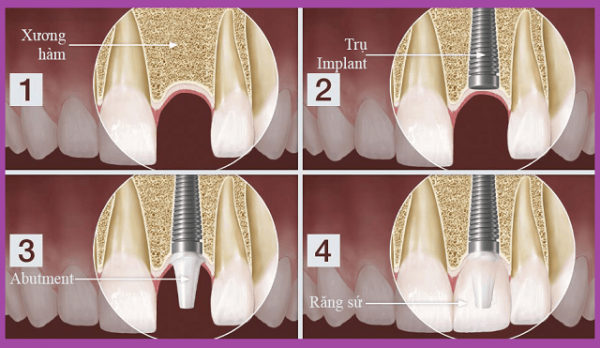 Trồng răng implant bảo tồn tối đa xương hàm