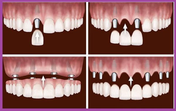 Kỹ thuật trồng implant đa dạng, khắc phục tốt mọi trường hợp mất răng