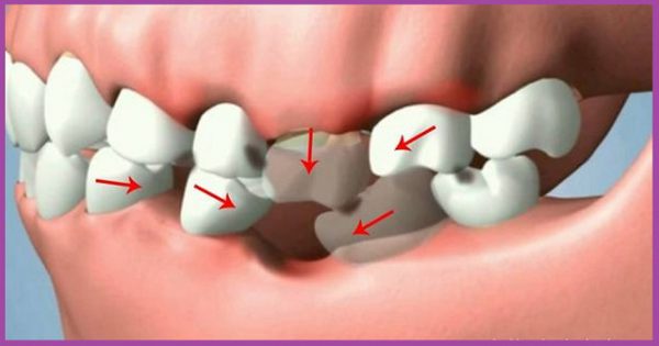 Răng dễ bị xô lệch, dịch chuyển vị trí do có khoảng trống mất răng