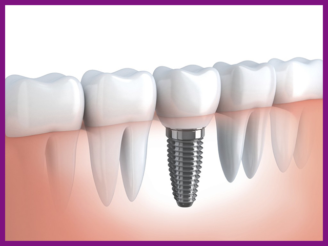 Công nghệ cấy răng Implant