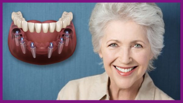 cấy ghép implant giúp ngăn ngừa tình trạng tiêu xương xảy ra ở người mất răng lâu năm