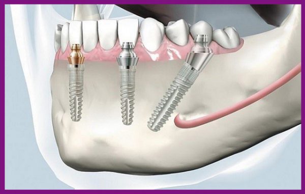 công nghệ làm răng implant có thể phục hồi rất tốt chức năng răng và thẩm mỹ răng miệng