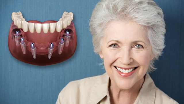 Công nghệ làm răng implant - Phục hình răng an toàn, tối ưu và toàn diện