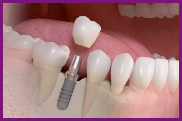 Trên trụ implant sẽ phục hình răng sứ, giống như răng thật
