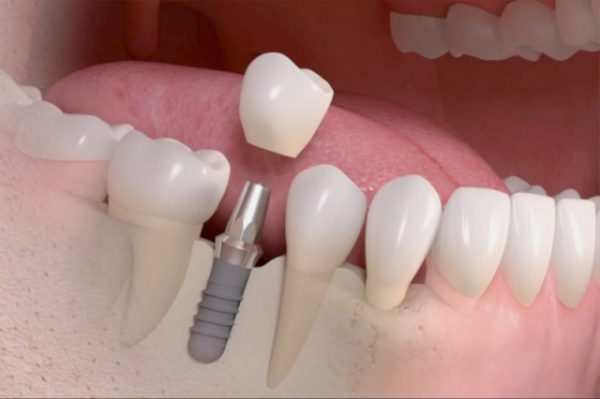 Công nghệ răng implant và những điều cần biết