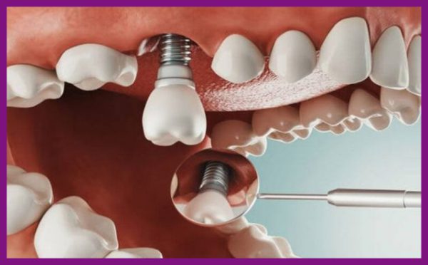 Cộng nghệ trồng răng Implant