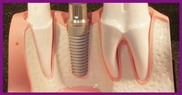 trụ implant đóng vai trò là chân răng thật, rất bền và chắc chắn, không dễ bị lung lay, sứt mẻ