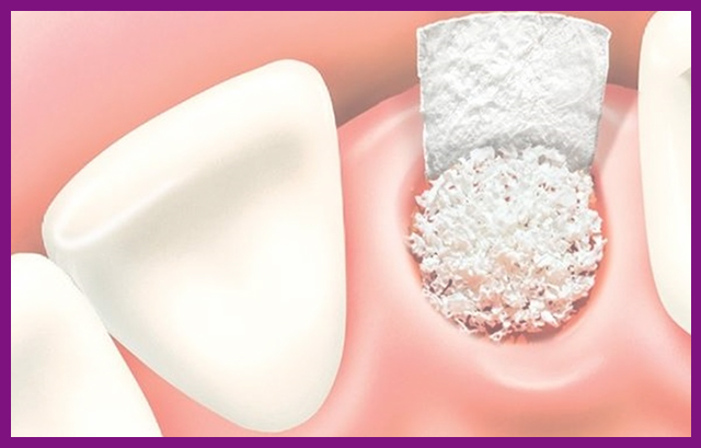 Ghép xương hàm trong trồng răng Implant