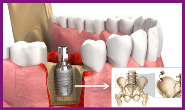 ghép xương thích hợp với bệnh nhân bị tiêu xương hàm, mất răng lâu năm