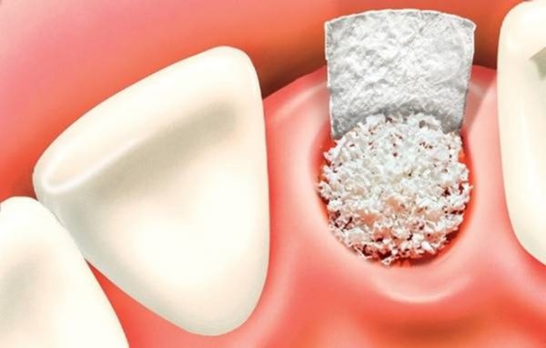 Tìm hiểu về phẫu thuật ghép xương răng trong cấy ghép implant