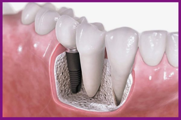 răng implant cho tuổi thọ cao, bền vững với thời gian